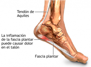 Fascitis Plantar